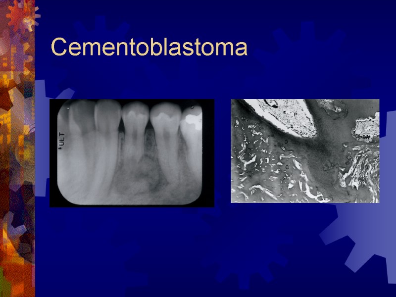 Cementoblastoma